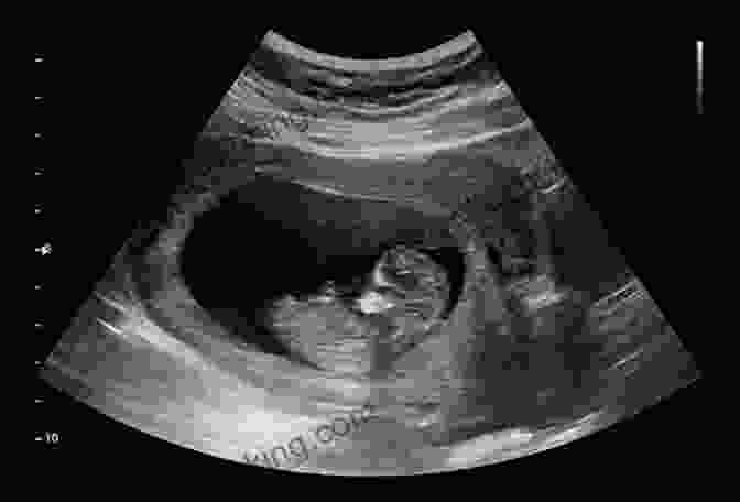 Ultrasound Image Of A Developing Fetus Pregnancy Baby Guide By Mumbook